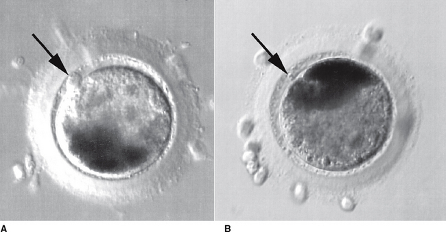 In Vitro Fertilization | Veterian Key