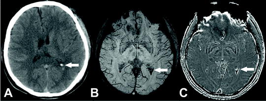 Subarachnoid hemorrhage MRI - Questions and Answers ​in MRI