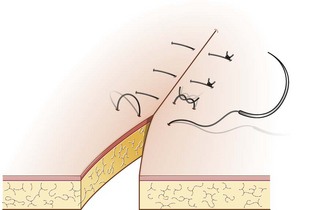 Vertical mattress suture pattern. 