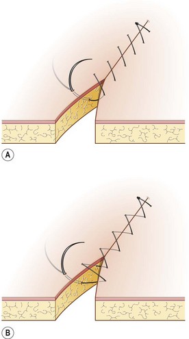 Common Suture Patterns