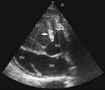 Aortic/Pulmonic Regurgitation, Acquired | Veterian Key