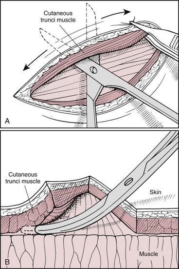 Wound Closure Techniques