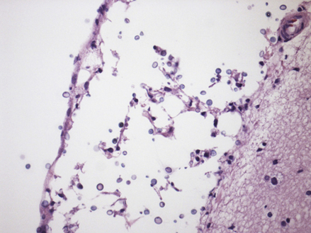 Cryptococcosis | Veterian Key