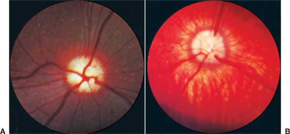 detached retina in dogs