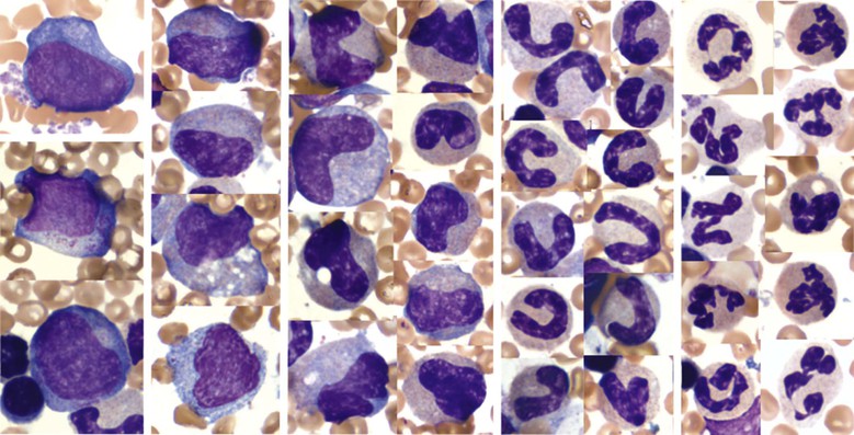 Collection And Analysis Of Bone Marrow | Veterian Key