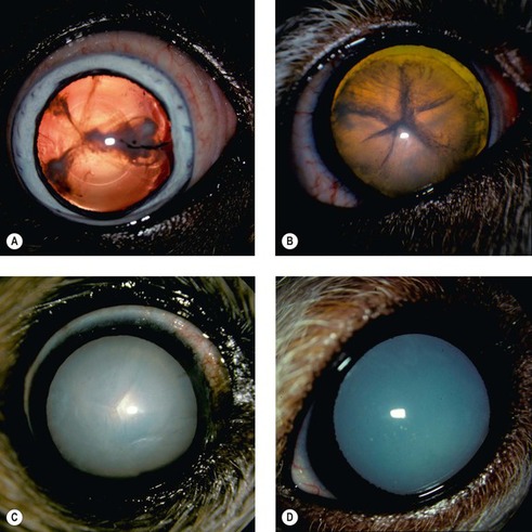 lens cataract immature mature posterior opacities diseases figure cataracts