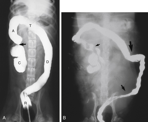 Ascending Colon Cat