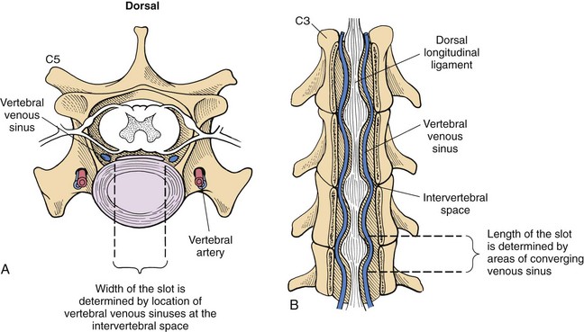 Ventral Slot Surgery Canine