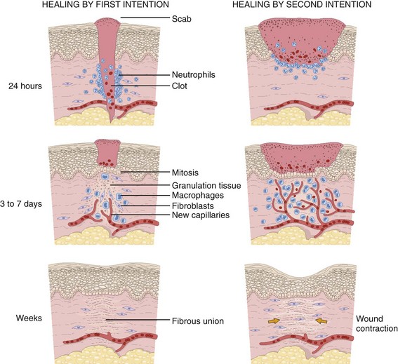 cauterization of granulation tissue