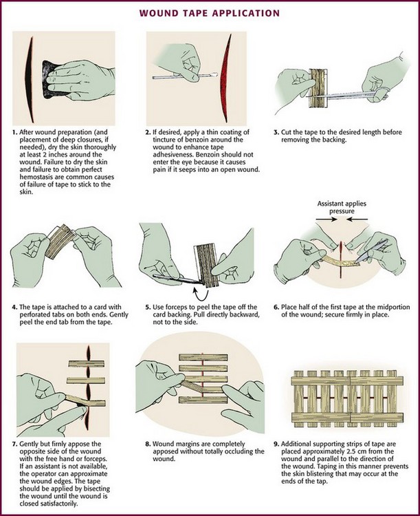 Adhesive tape, stitches, staples, zipper, glue: How to choose? - PerfectSeal