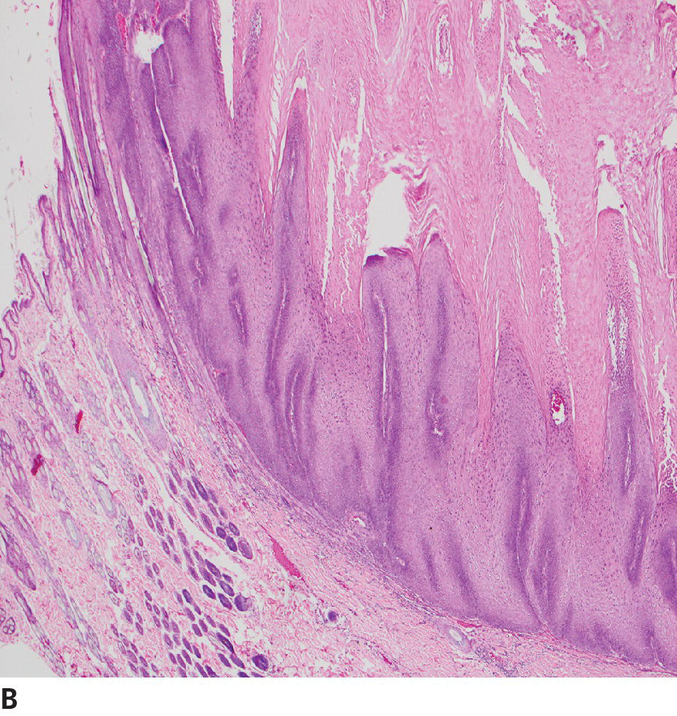 Epithelial And Melanocytic Tumors Of The Skin | Veterian Key