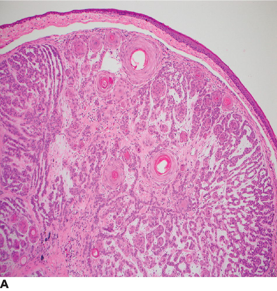 Epithelial And Melanocytic Tumors Of The Skin | Veterian Key