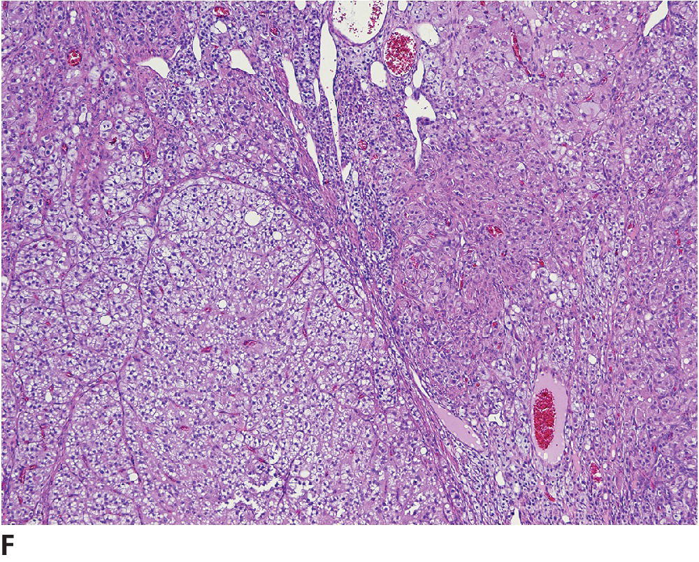 Tumors Of The Genital Systems | Veterian Key