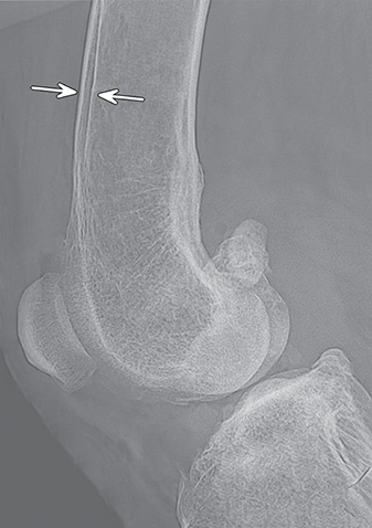 Photograph of greenstick fracture.