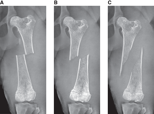 Photograph of simple complete fractures.
