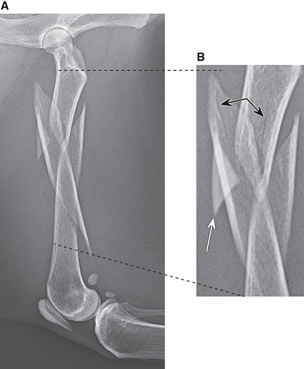 Photograph of comminuted fracture.