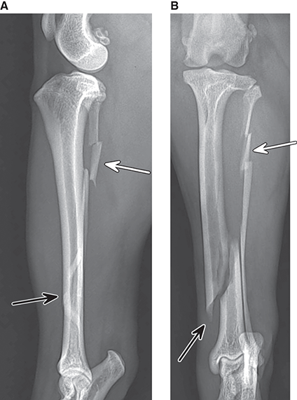Photograph of spiral and segmental fractures.