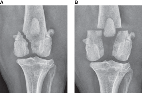 Photograph of condylar fractures.