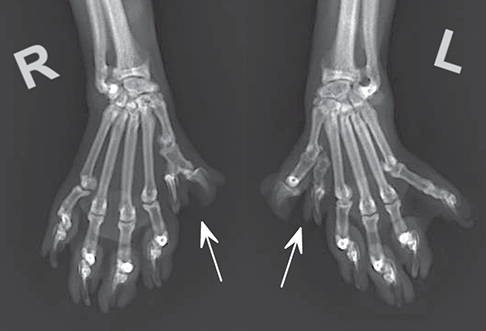 Photograph of polydactyly.