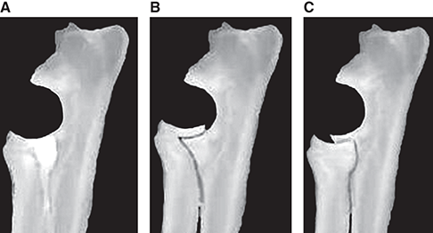 Photograph of elbow subluxation.