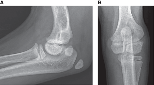 Photograph of normal immature canine elbow.