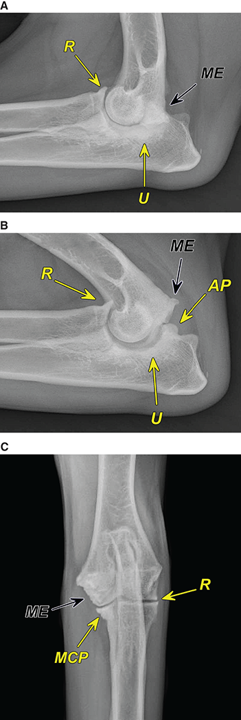 Photograph of elbow DJD.