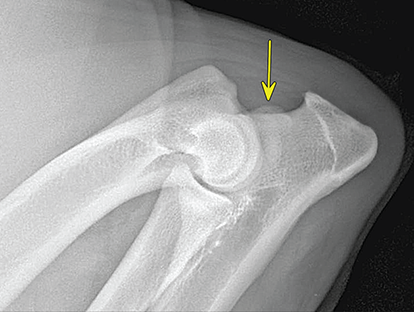 Photograph of elbow “bump”.