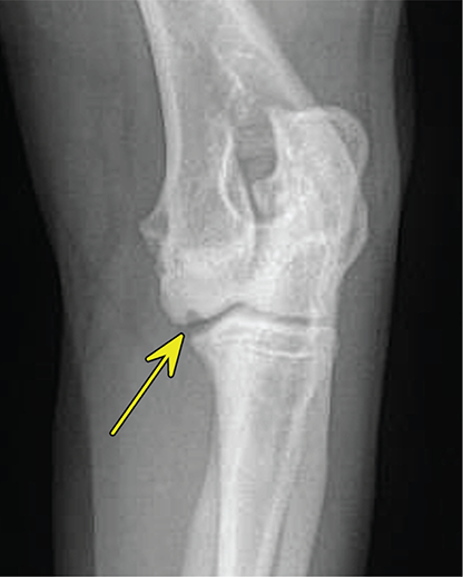 Photograph of osteochondrosis.