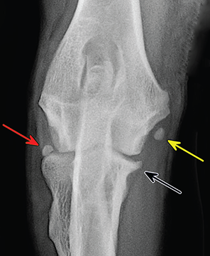 Photograph of ununited medial humeral epicondyle.
