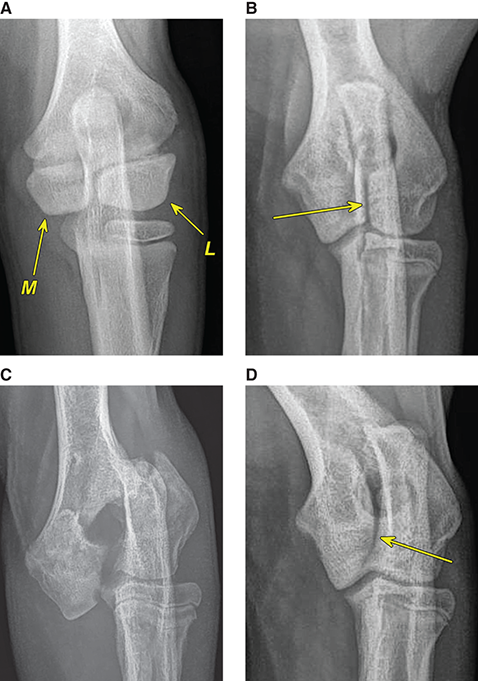 Photograph of incomplete ossification of humeral condyle.