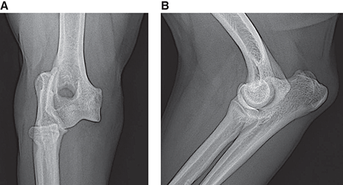 Photograph of elbow luxation.