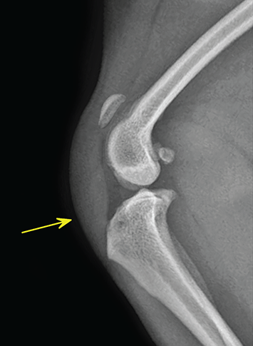 Photograph of ruptured patellar ligament.