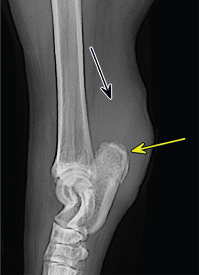Photograph of common calcanean tendon injury.