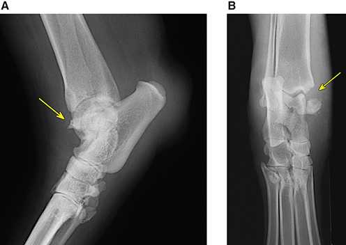 Photograph of fractured medial malleolus.