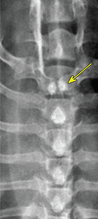 Photograph of spina bifida.