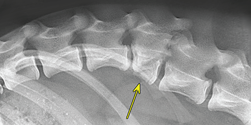 Photograph of compression fracture.