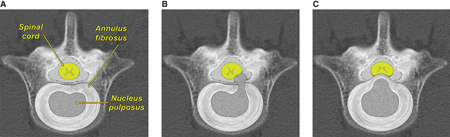 Photograph of intervertebral disc herniation.
