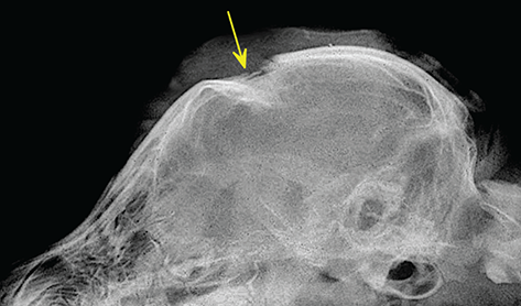 Photograph of skull fracture.