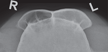Photograph of frontal sinus mucocele.
