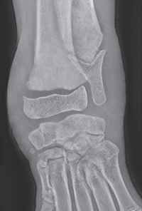 Photo depicts Salter–Harris classification of fractures- Type 1.