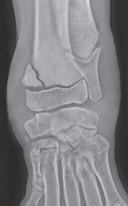 Photo depicts Salter–Harris classification of fractures- Type 2.