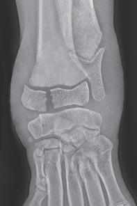 Photo depicts Salter–Harris classification of fractures- Type 3.
