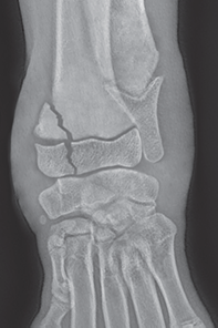 Photo depicts Salter–Harris classification of fractures- Type 4.