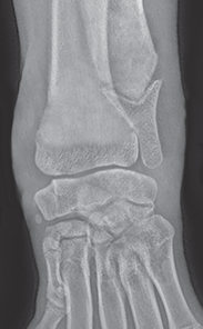 Photo depicts Salter–Harris classification of fractures- Type 5.