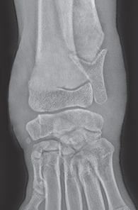 Photo depicts Salter–Harris classification of fractures- Type 6.